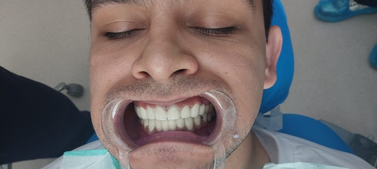 после протезирования зубов в Китае