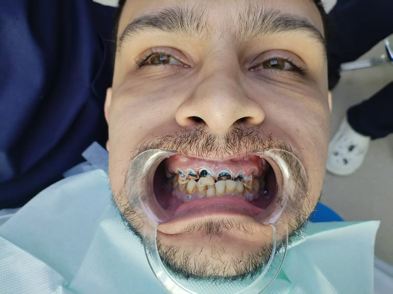 до протезировании зубов в Китае