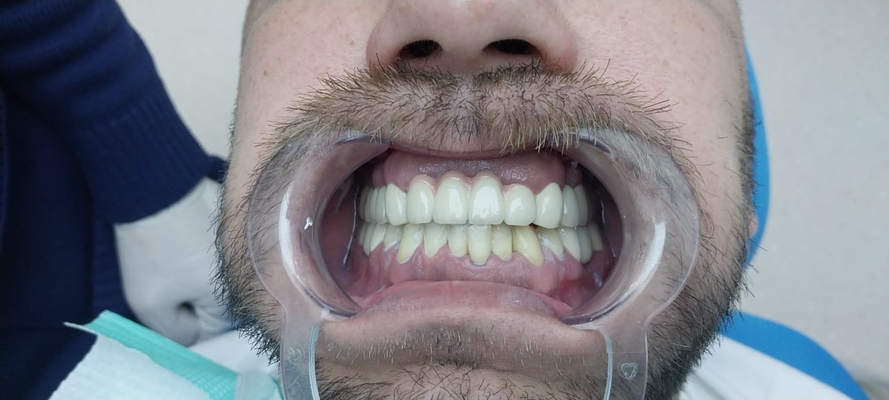 после протезирования зубов в Китае