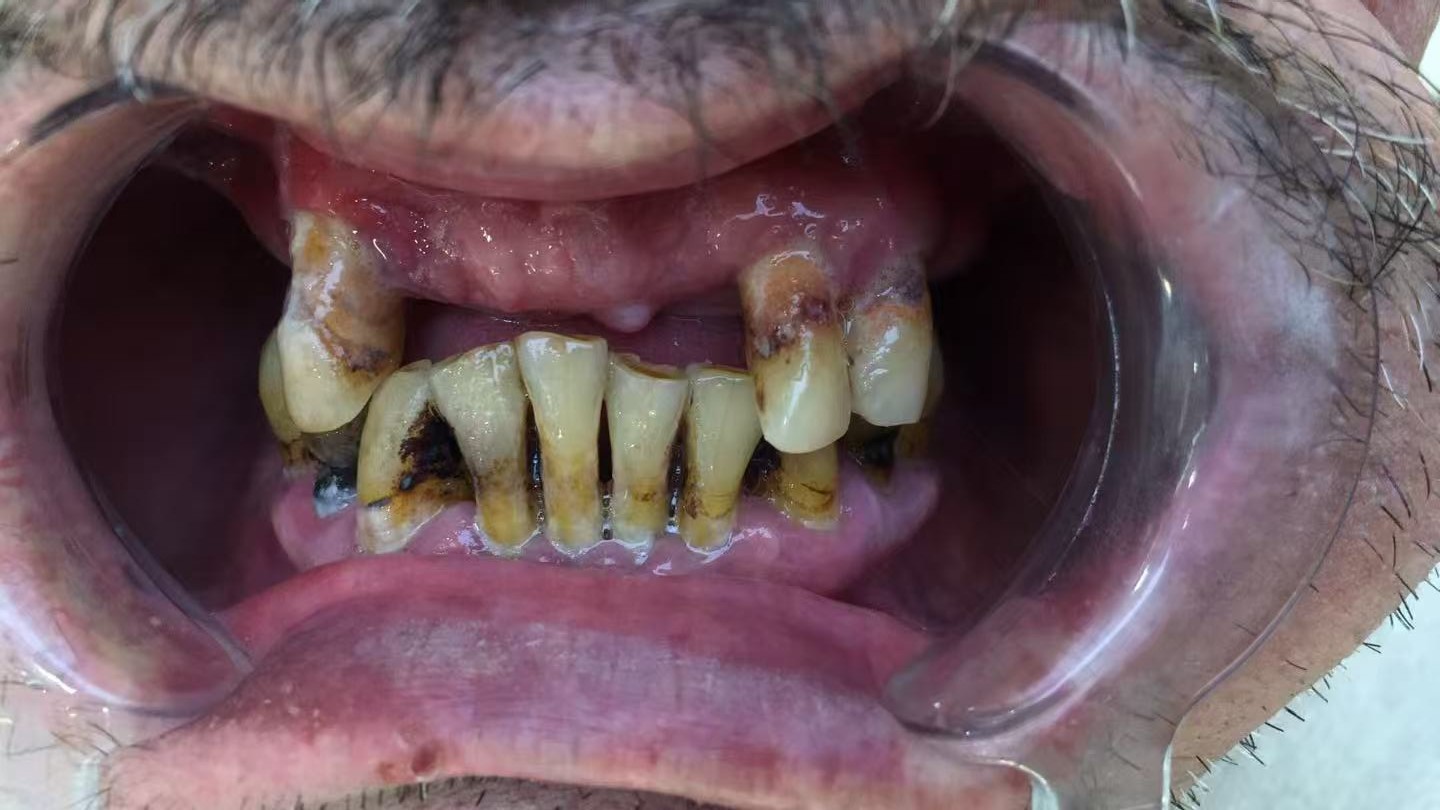 до протезировании зубов в Китае