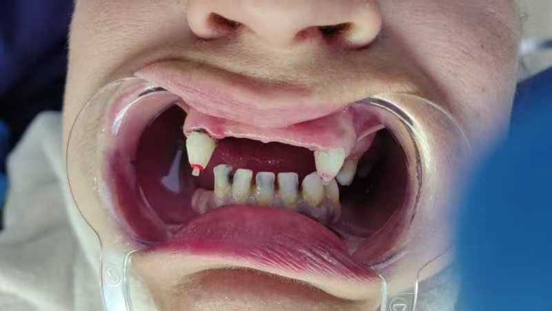 до протезировании зубов в Китае