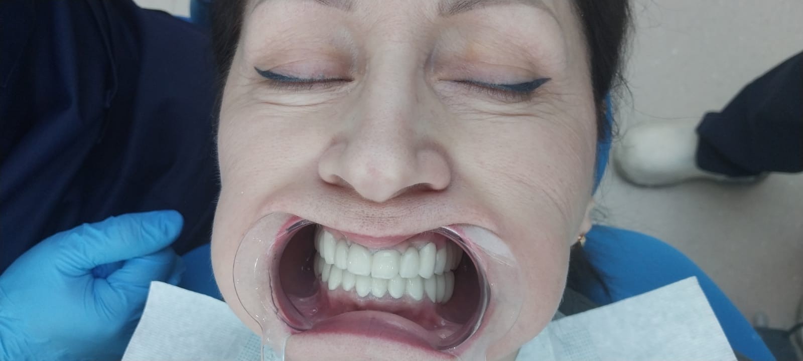 после протезирования зубов в Китае