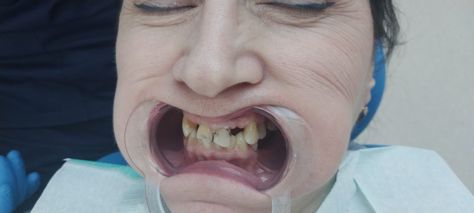 до протезировании зубов в Китае